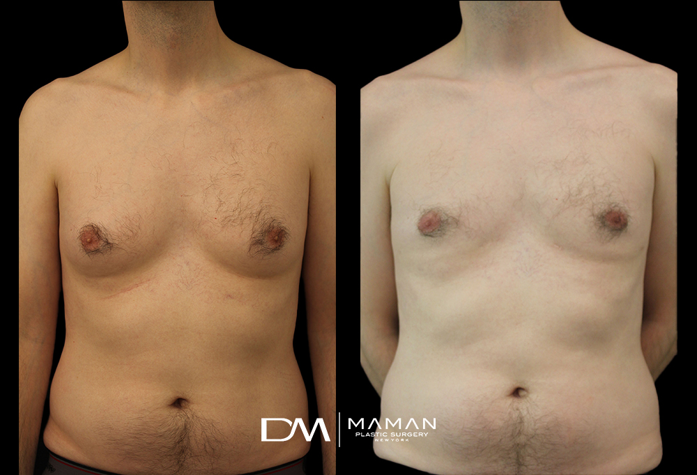 Male Breast Reduction (A.G.)