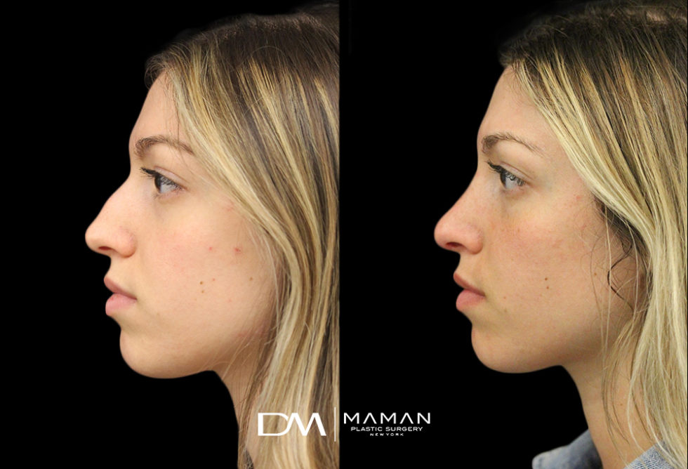 Rhinoplasty NYC Best New York City Nose Job Surgeon