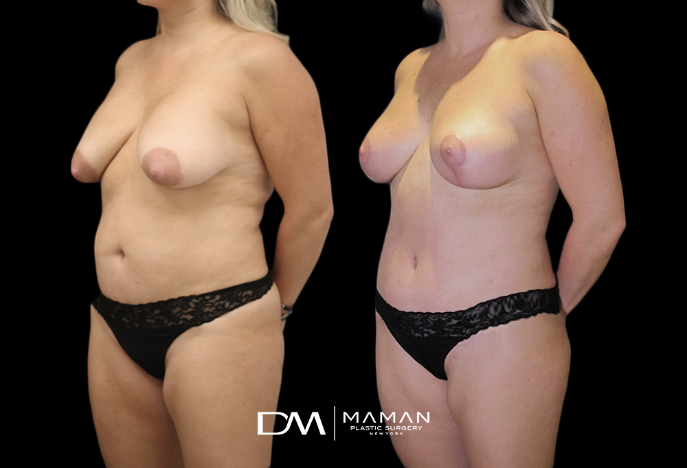 Liposuction Durkin LO